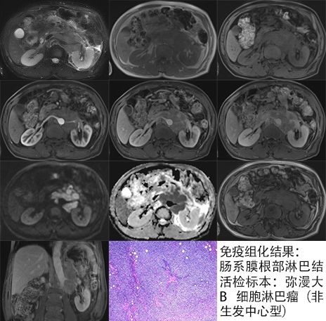 【病例】腹膜后占位1例—见缝就钻、包绕血管