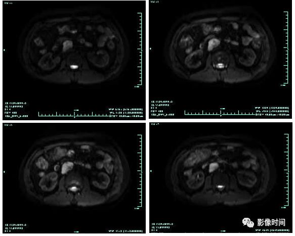 【病例】腹膜后占位1例—见缝就钻、包绕血管