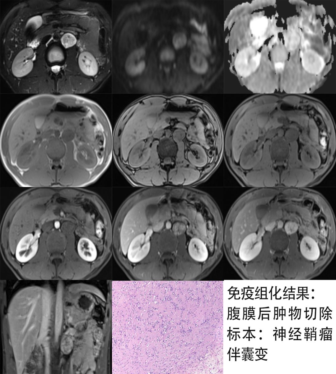 【病例】腹膜后占位1例—见缝就钻、包绕血管