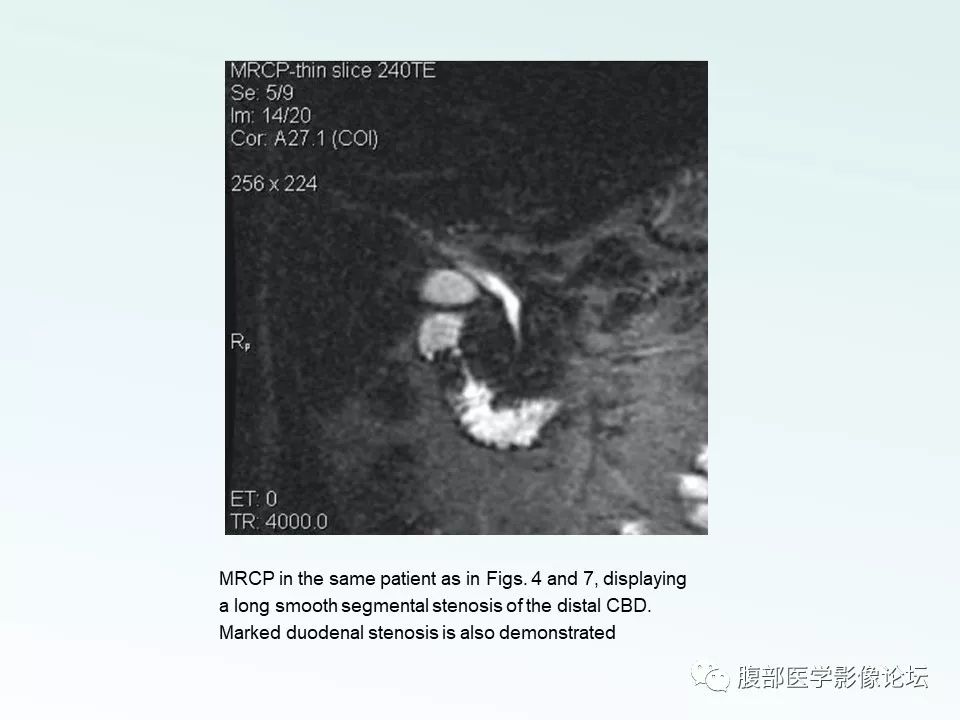 【PPT】沟槽性胰腺炎