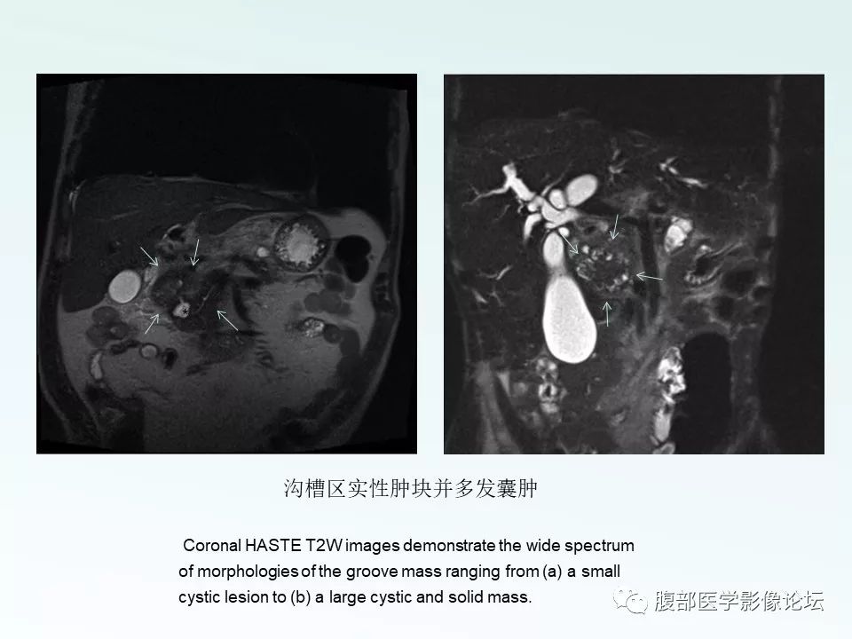 【PPT】沟槽性胰腺炎
