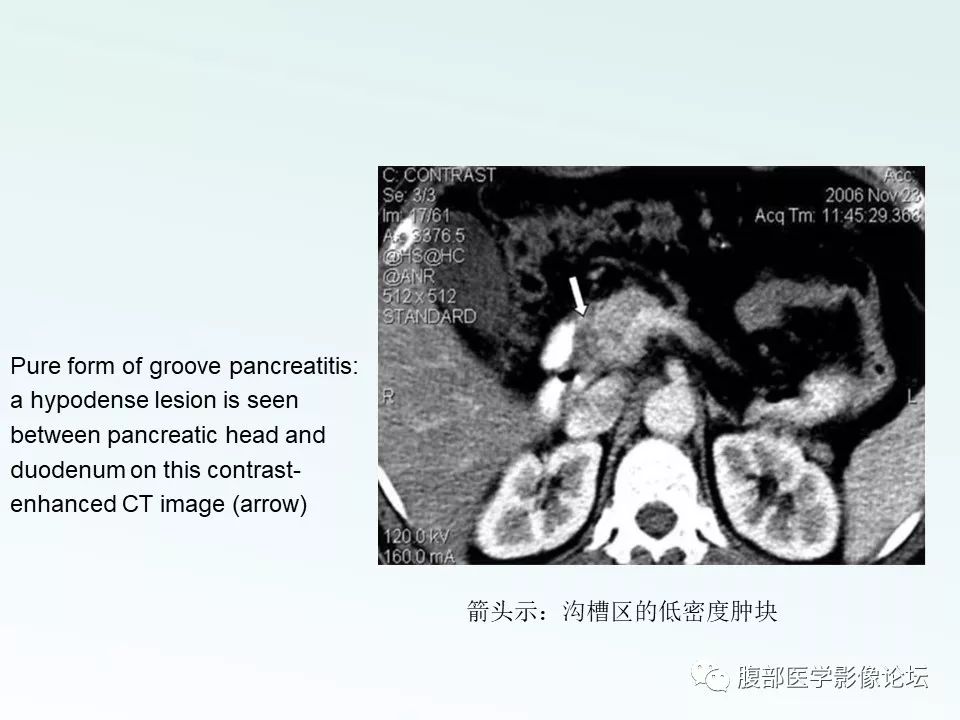 【PPT】沟槽性胰腺炎