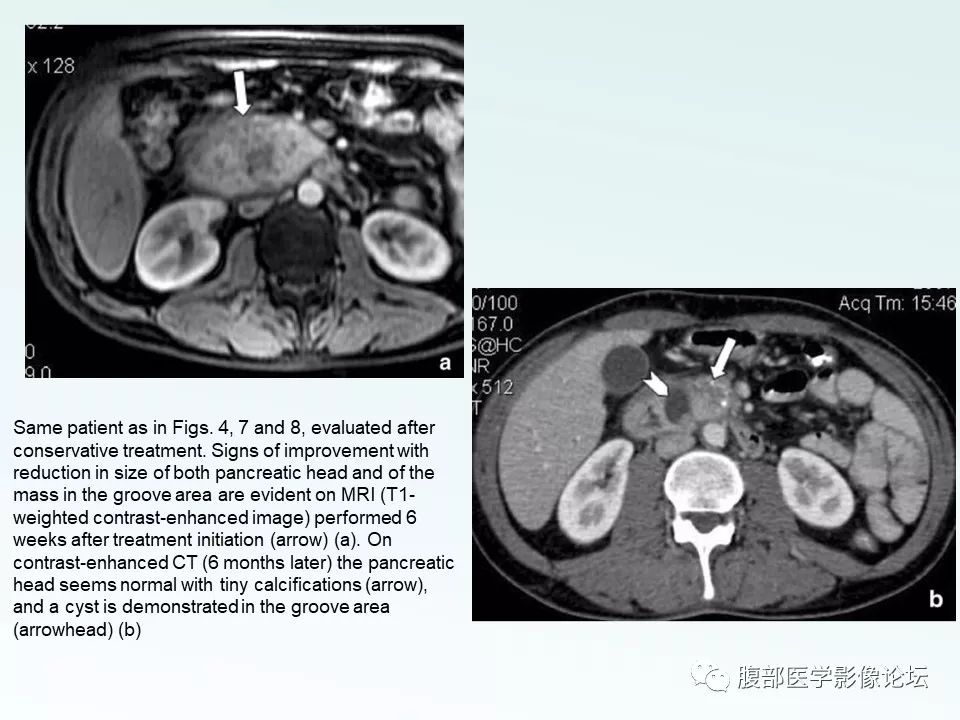 【PPT】沟槽性胰腺炎