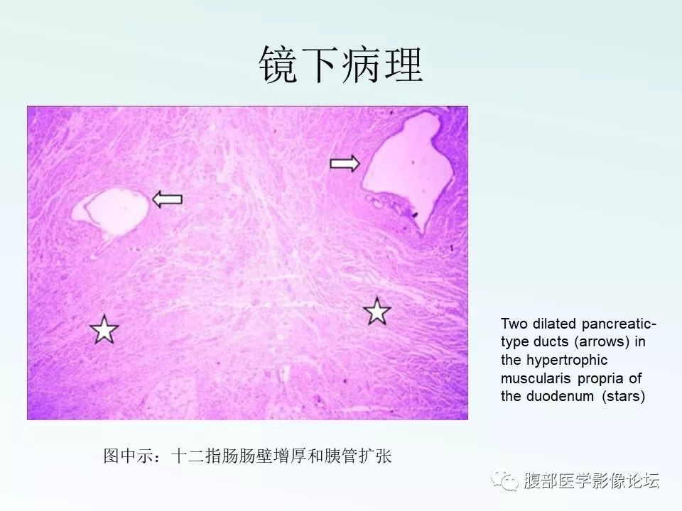 【PPT】沟槽性胰腺炎