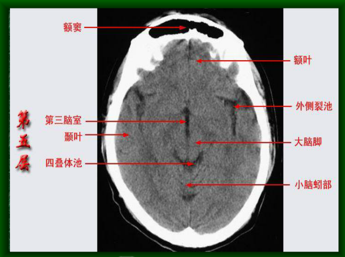 头颅CT断层解剖图片