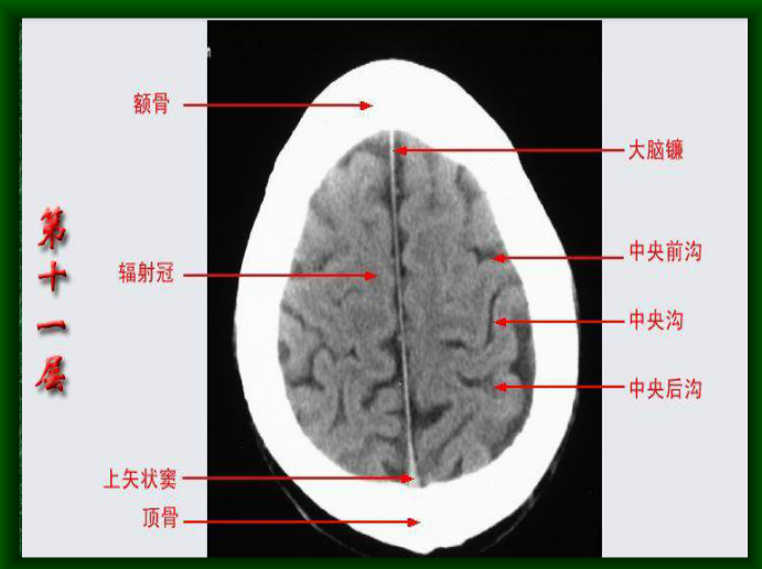头颅CT断层解剖图片