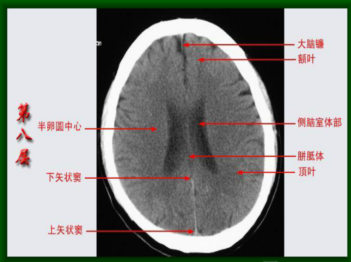 头颅CT断层解剖图片