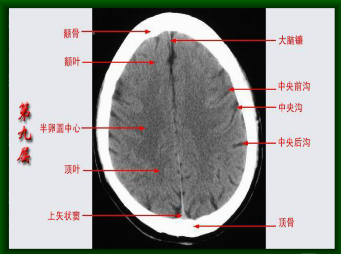 头颅CT断层解剖图片