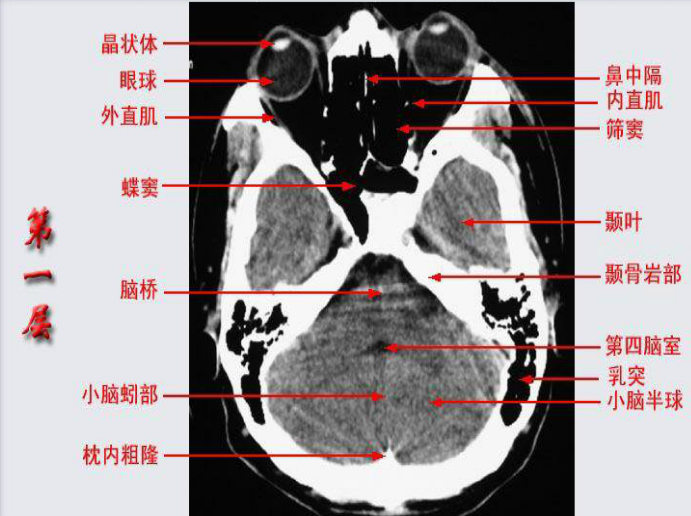 头颅CT断层解剖图片
