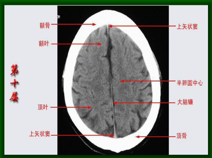 头颅CT断层解剖图片