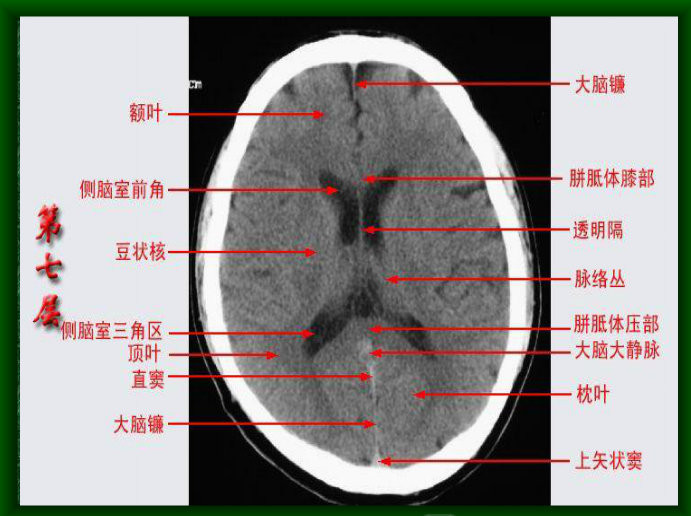 头颅CT断层解剖图片