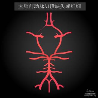 大脑Willis环的解剖及变异