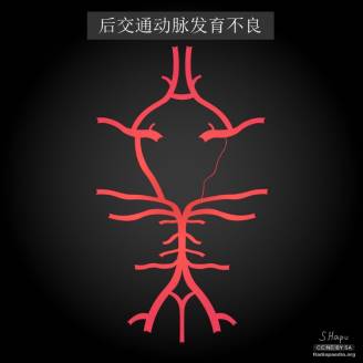 大脑Willis环的解剖及变异