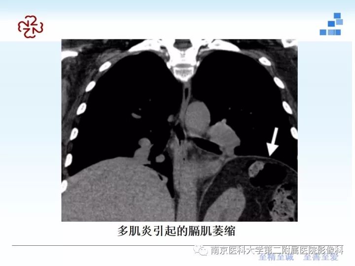 【PPT】膈肌的解剖及病变