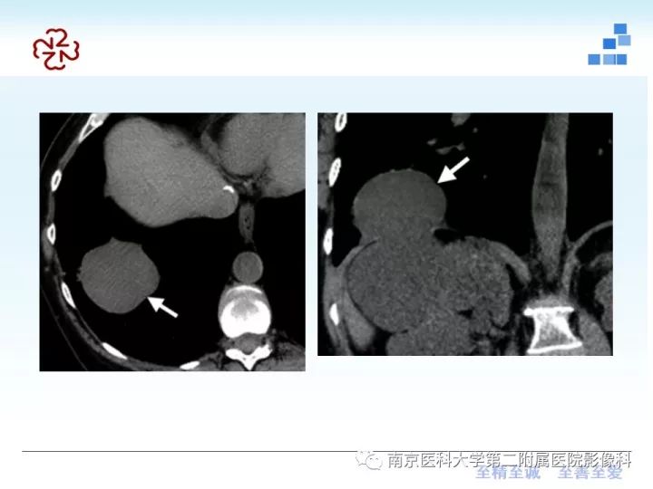 【PPT】膈肌的解剖及病变