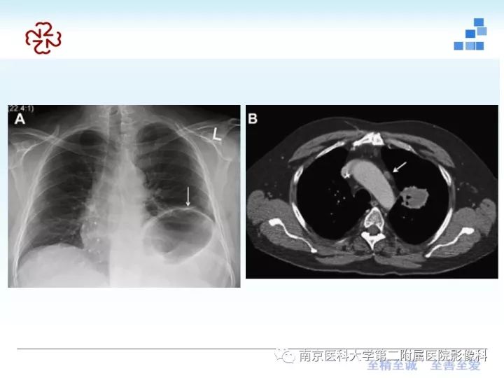 【PPT】膈肌的解剖及病变