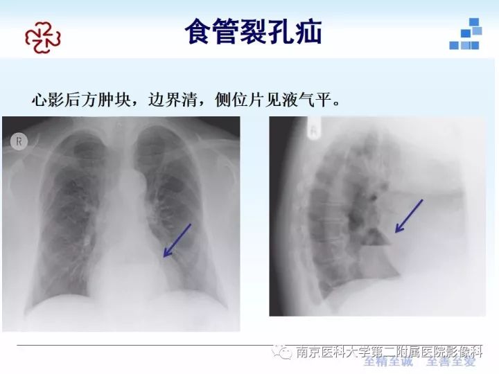 【PPT】膈肌的解剖及病变