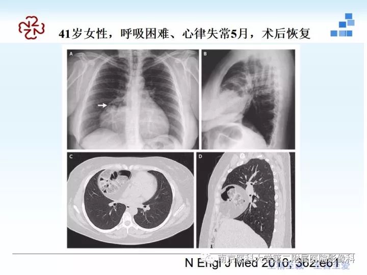 【PPT】膈肌的解剖及病变