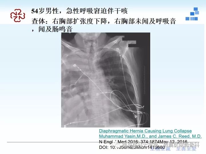 【PPT】膈肌的解剖及病变