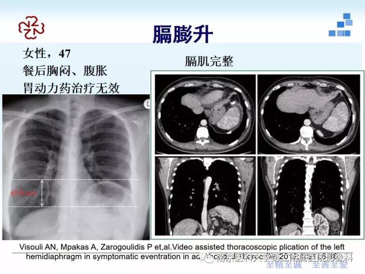 【PPT】膈肌的解剖及病变