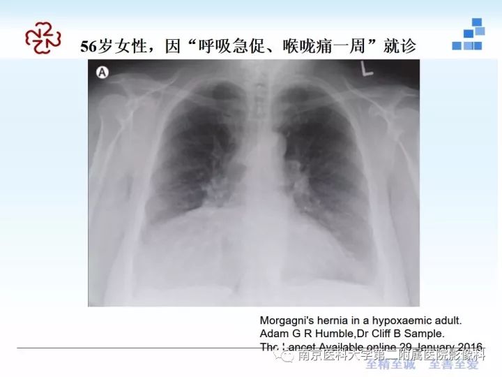 【PPT】膈肌的解剖及病变