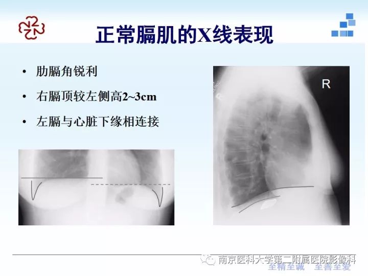 【PPT】膈肌的解剖及病变