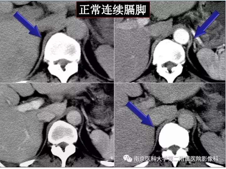 【PPT】膈肌的解剖及病变