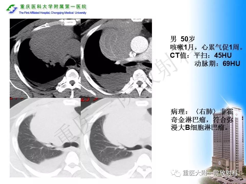 【PPT】原发性肺淋巴瘤