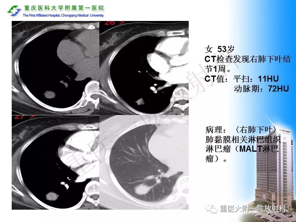 【PPT】原发性肺淋巴瘤