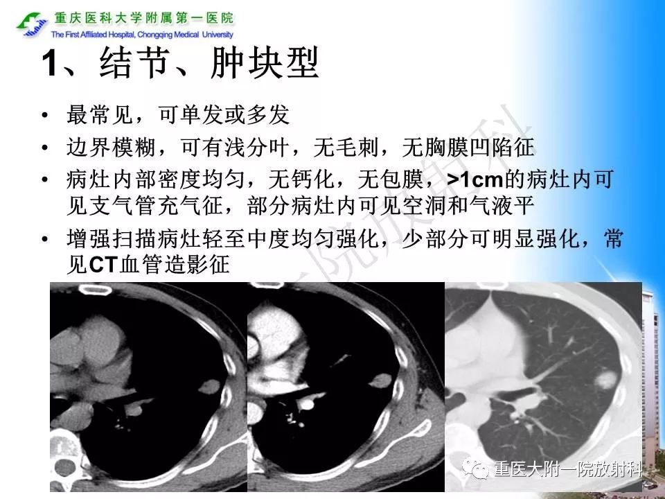 【PPT】原发性肺淋巴瘤