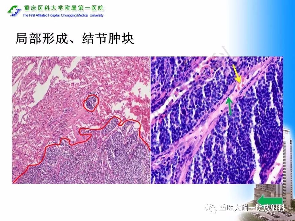 【PPT】原发性肺淋巴瘤