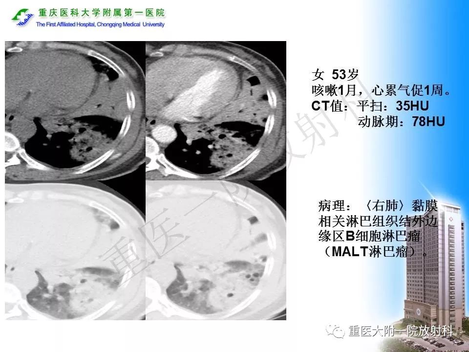 【PPT】原发性肺淋巴瘤