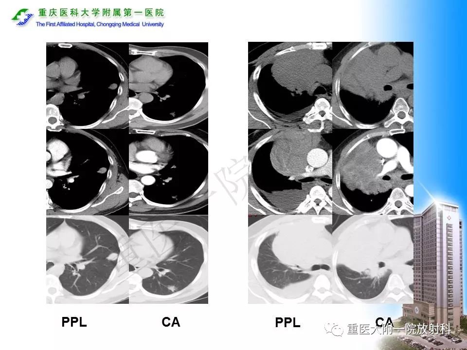 【PPT】原发性肺淋巴瘤