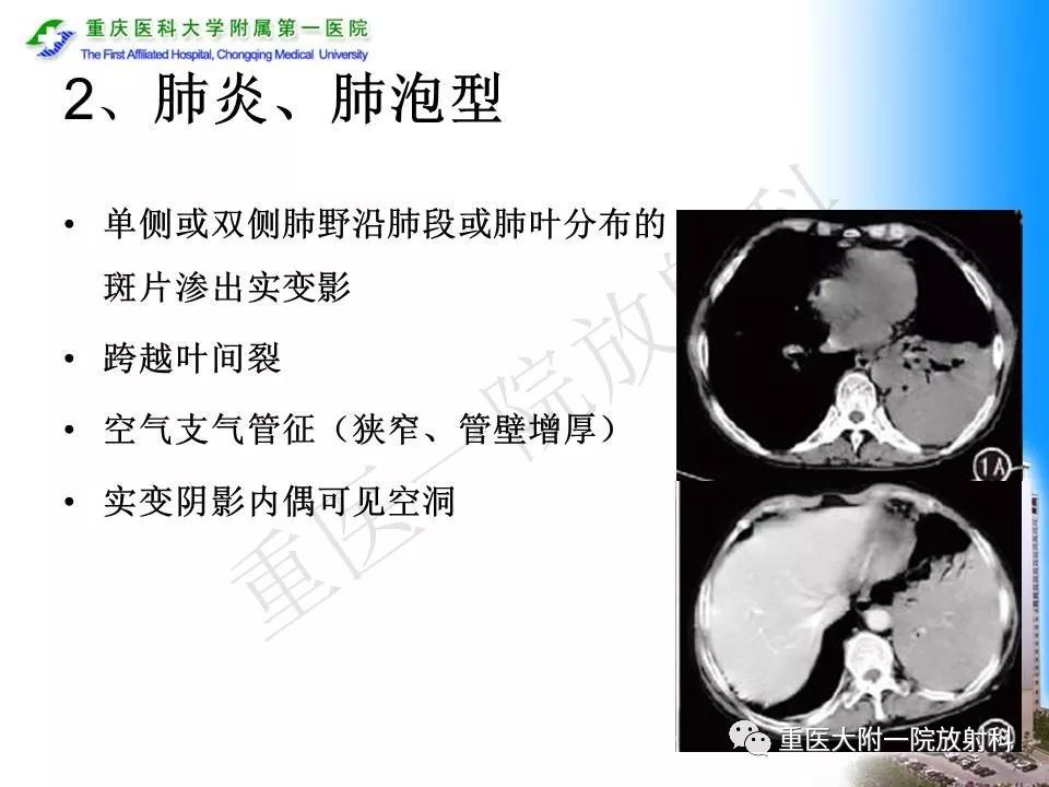 【PPT】原发性肺淋巴瘤