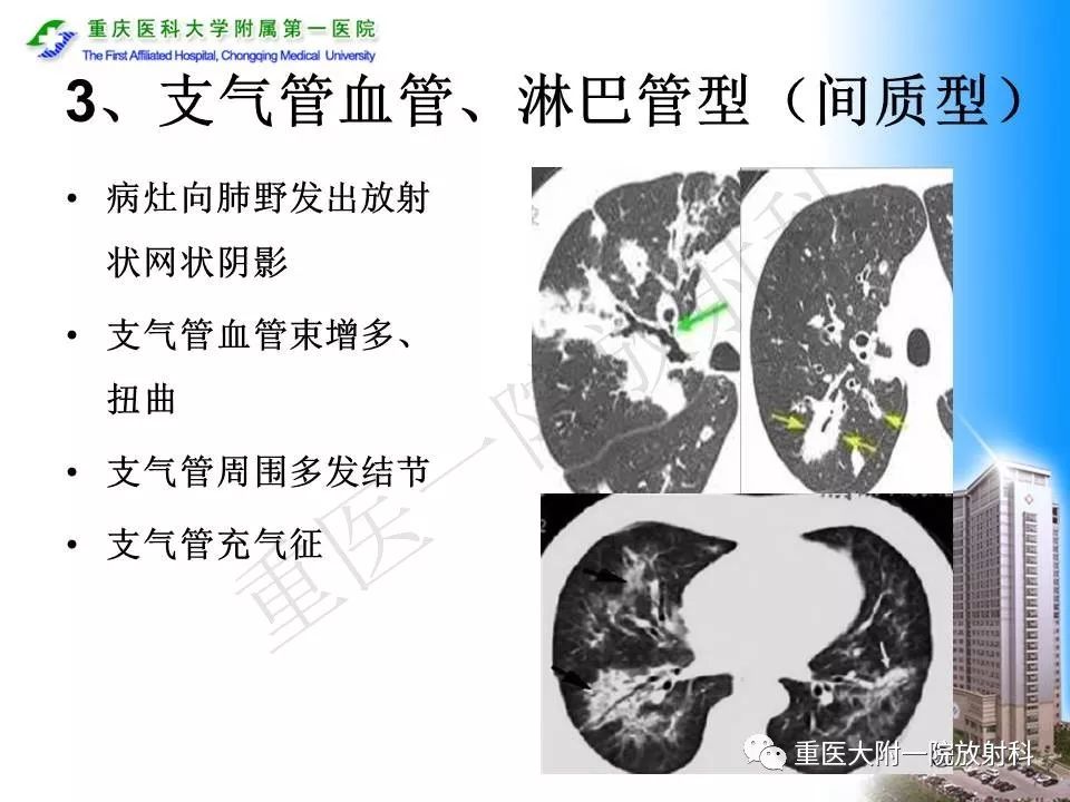【PPT】原发性肺淋巴瘤