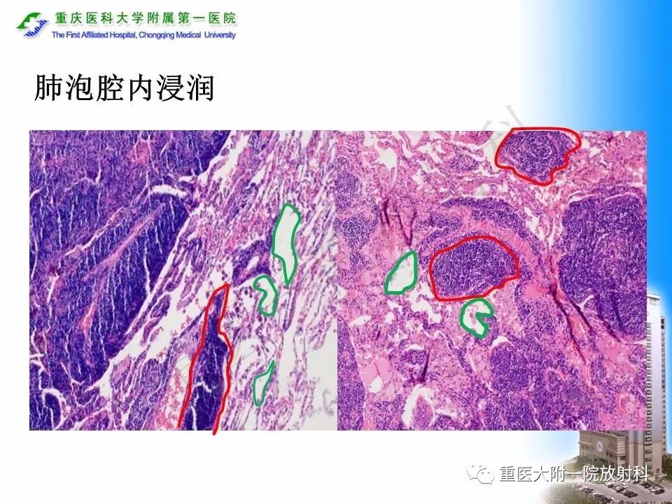 【PPT】原发性肺淋巴瘤