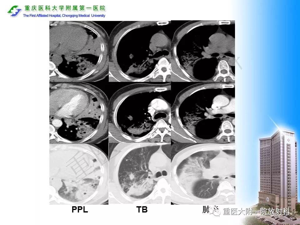 【PPT】原发性肺淋巴瘤