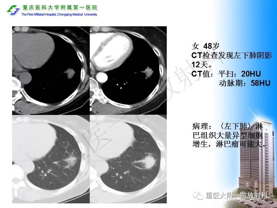 【PPT】原发性肺淋巴瘤