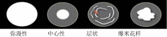肺内孤立性结节高危CT征象