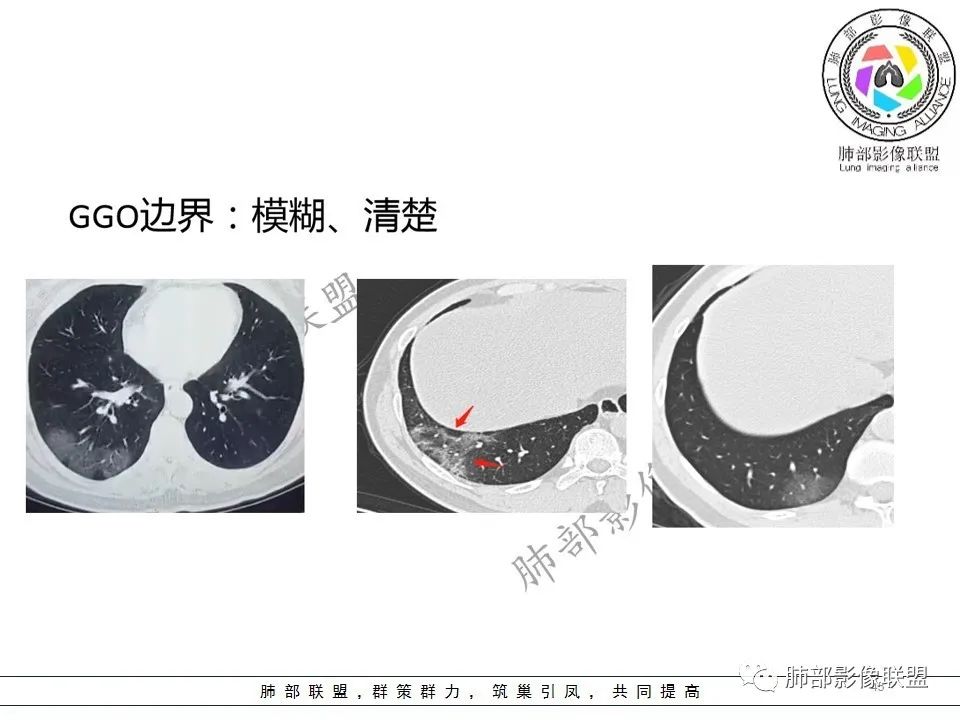 【PPT】关于180余例新冠肺炎(NCP)的影像分析与思考