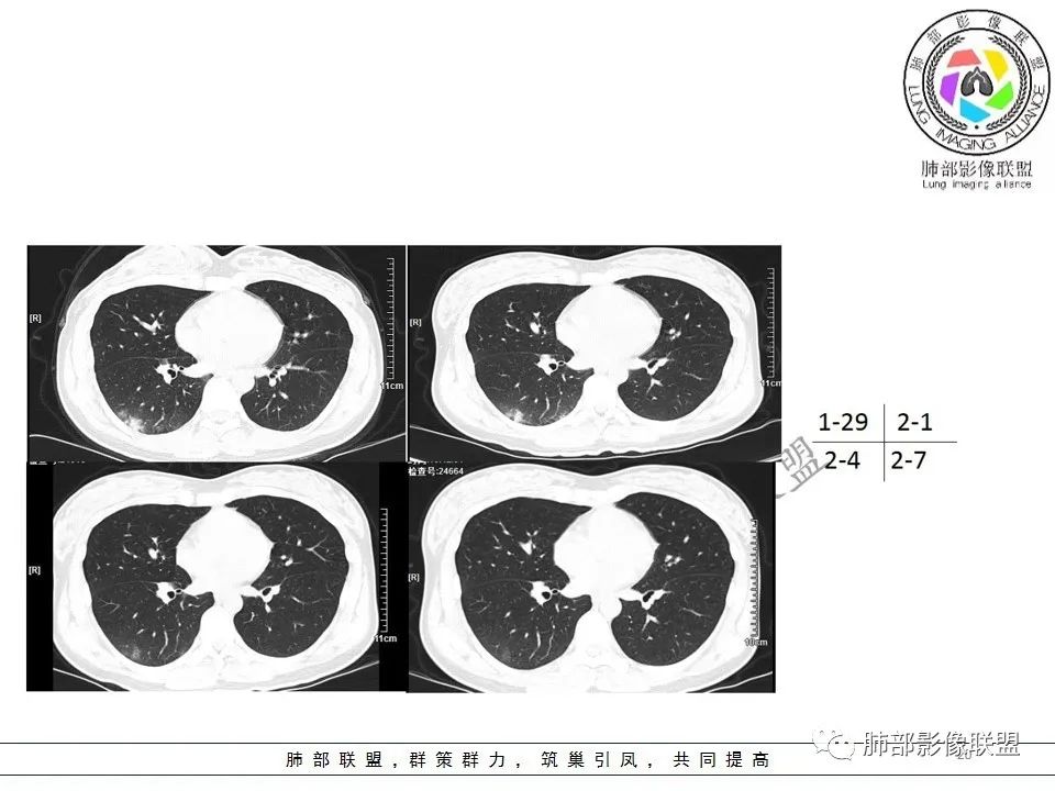 【PPT】关于180余例新冠肺炎(NCP)的影像分析与思考