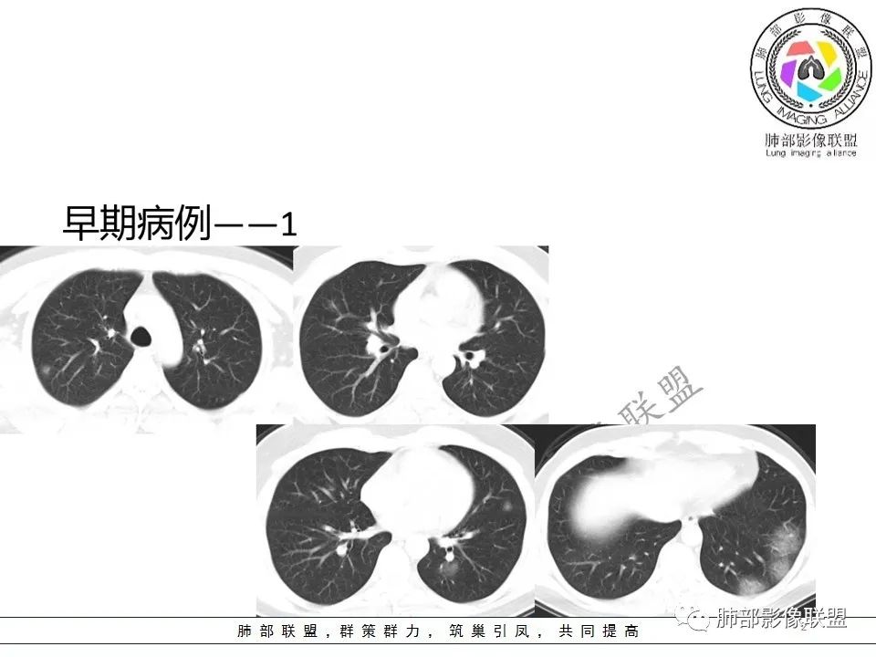【PPT】关于180余例新冠肺炎(NCP)的影像分析与思考
