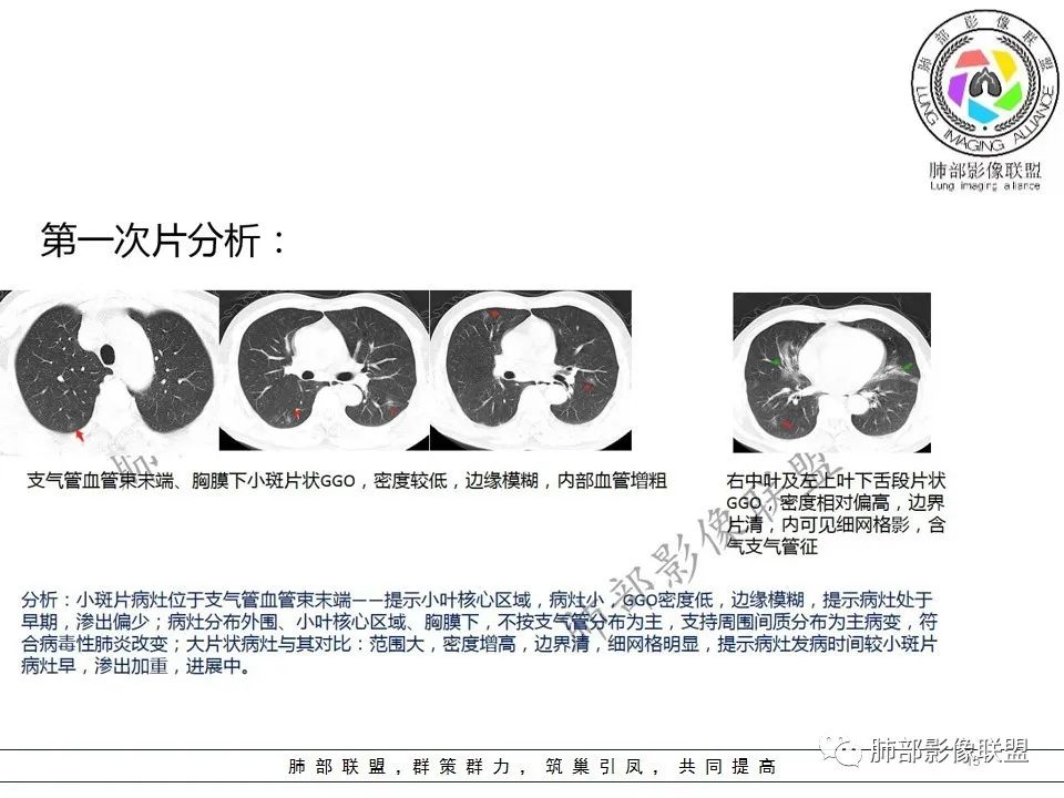 【PPT】关于180余例新冠肺炎(NCP)的影像分析与思考