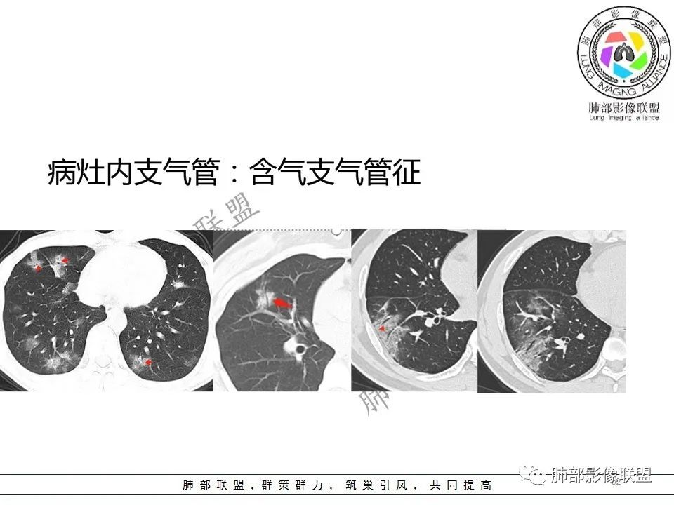 【PPT】关于180余例新冠肺炎(NCP)的影像分析与思考