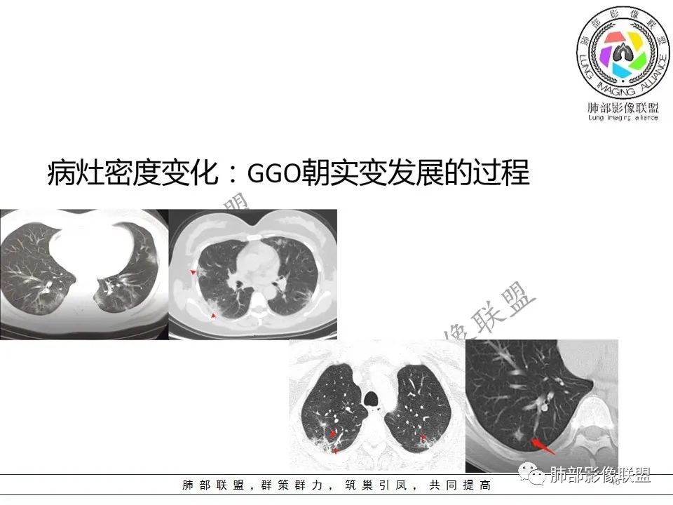 【PPT】关于180余例新冠肺炎(NCP)的影像分析与思考