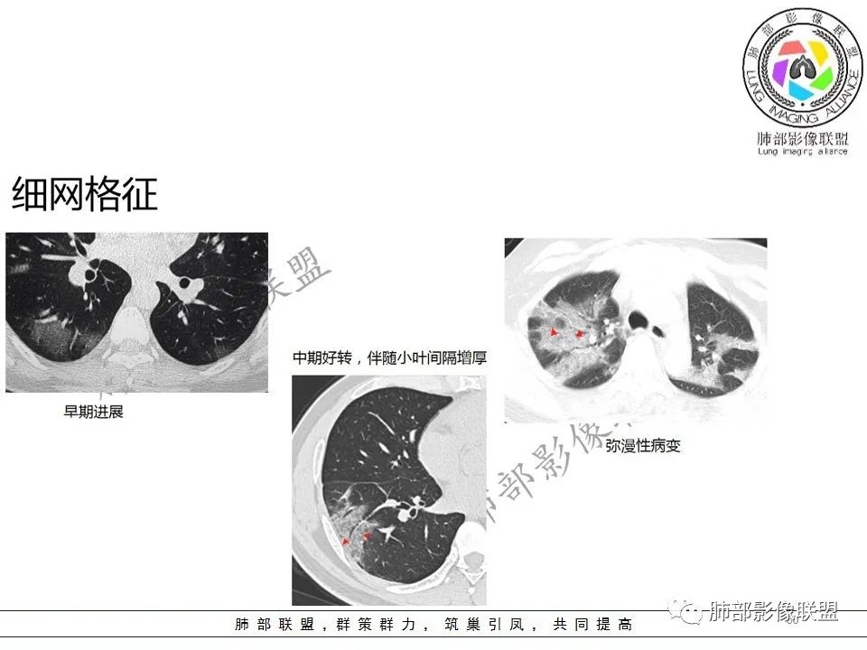 【PPT】关于180余例新冠肺炎(NCP)的影像分析与思考