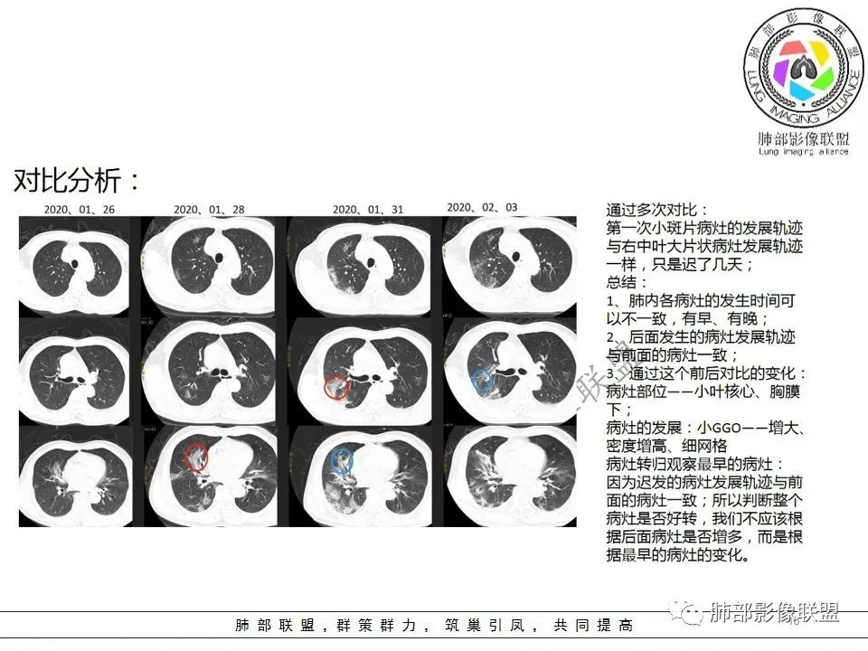 【PPT】关于180余例新冠肺炎(NCP)的影像分析与思考