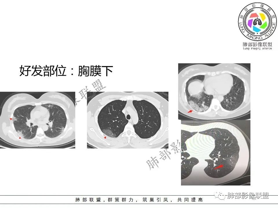 【PPT】关于180余例新冠肺炎(NCP)的影像分析与思考