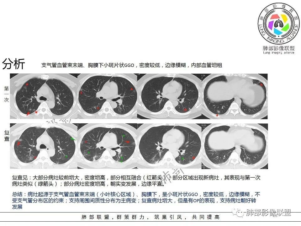 【PPT】关于180余例新冠肺炎(NCP)的影像分析与思考