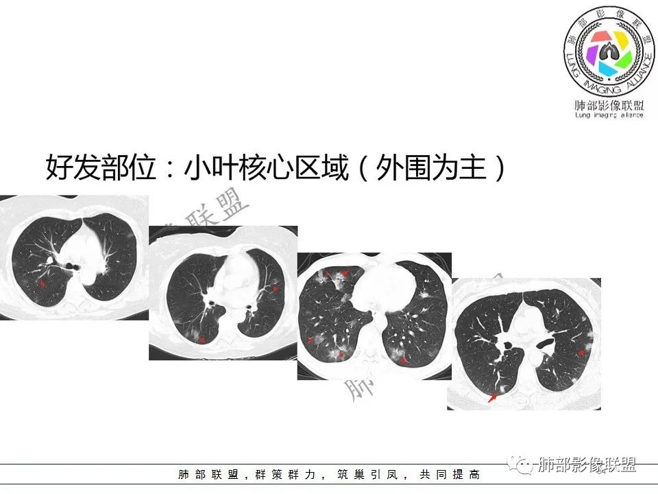【PPT】关于180余例新冠肺炎(NCP)的影像分析与思考
